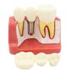 4 Times Dental Implant Model Enlarged Size Removable Analysis Crown Bridge Demonstration Teeth Model view 1