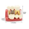 4 Times Dental Implant Model Enlarged Size Removable Analysis Crown Bridge Demonstration Teeth Model view 2