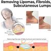 Ashopfun HuangFuTang Lipoma Removal Cream, Instant Lump-Free Lipoma Removal Cream, Get Rid of Your Fatty Lumps (1 Pcs) view 3
