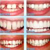 Flipped Warmth 60G Tooth Repair Granules,Temporary Tooth Filling,Tooth Filling Repair Kit,Temporary Tooth Repair,Tooth Repair Beads, for Temporary Fixing The Missing And Broken Tooth Replacements view 4