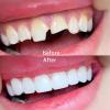 Brigtviee Tooth Filling Repair Kit,Temporary Tooth Repair Kits Moldable False Teeth Tooth Repair Granules,for Missing And Broken Tooth Replacements for Confident Smile view 3