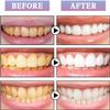 Teeth Whitening Pen Teeth Whitening Pen Teeth Whitening Pen Teeth Whitening Kit Teeth Whitening Kit to Remove Stains view 2