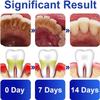 GFOUK Essence Teeth Whitening Kit - Professional Home Whitening System,Teeth whitening kit, Home whitening System, Professional Teeth whitening, GFOUK Essence (1PC) view 3