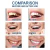 PureSmile Essence Teeth Whitening Essence Kit Teeth Whitening Kit Professional Home Whitening System Maintain Oral Health view 2