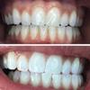 HeySmile Teeth Whitening Strips - No Sensitivity - Instant Results - Pack of 28 Strips - 14 Treatments - Up to 10 Shades Whiter Teeth - Scientifically Proven - Vegan Friendly view 4