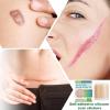 JINGAN Scar Stickers | Soft and Flexible Silicone Scar Removing Tapes,Tummy Tuck Scars Removal Sheets for Traveling, Beach Vacation, Business Trips, Home, Working view 3