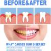 Neslemy Gum Shield Therapy Gel and Whitening, Neslemy Gum Gel, Dentizen Gum Therapy Gel, Teeth Whitening Essence Pen, Deeply Cleaning Gums, Enhances Overall Gum Health (5Pcs) view 4