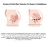Hydravex Pelvic Muscle Trainer, Pelvic Floor Muscle Repair Instrument, Postpartum Recovery Pulse Pelvic Floor Magnetic, Alleviating Women's Urinary Incontinence view 3