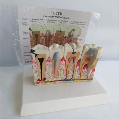 Human Tooth Model, Pathological Tooth Oral Model, Desktop Dental Manifestation with Explanation Board, Dental Teeth Decay Anatomical Model Teaching Model for Science Classroom.