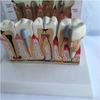 Human Tooth Model, Pathological Tooth Oral Model, Desktop Dental Manifestation with Explanation Board, Dental Teeth Decay Anatomical Model Teaching Model for Science Classroom. view 2