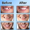Tooth Filling Repair Kit,Dental Temporary Tooth Filling for Missing Broken Tooth Moldable Fake Teeth10ml view 3