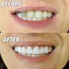 Dazzluxe 2 Pairs Dentures Cosmetic Veneer False Teeth, Temporary Veneers White Snap on False Teeth for Women Men, Protect Your Teeth And Regain Confident Smile view 3