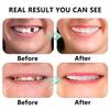 Dazzluxe 2 Pairs Instant Veneers Dentures, Comfort Fit Upper And Lower Teeth Veneers, Temporary Cosmetic Fake Teeth for Men Women Cover Missing Teeth view 2