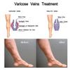sjfscqr Vericose Veins Treatment Blue Light Lazer Treatment Pen,Spider Vein Treatment for Legs,Varicose Veins Blue Light Therapy Set view 4