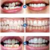 Brigtviee 2 Pairs Teeth Veneers, Veneers Snap in Braces Instant Perfect Smile Temporary Replacement Tooth Kit, DIY Temporary Fake Teeth for Snap on Instant Whitening & Confidence Smile view 4