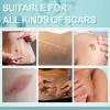 Apooliy Scar gel, Scar Removal Cream for Surgical Scars, Burns, Acne, Stretch Marks, Keloid Bumps,C Section Scars, Scar Treatments for Old and New Scars (50ml) view 2