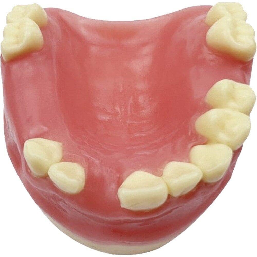 Maxillary Missing Dental Implant Model Oral Teeth Model with Soft Gums Tooth Implant Practice Medical Educational Training Aid Teaching Aids