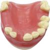 Maxillary Missing Dental Implant Model Oral Teeth Model with Soft Gums Tooth Implant Practice Medical Educational Training Aid Teaching Aids view 1