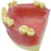 Maxillary Missing Dental Implant Model Oral Teeth Model with Soft Gums Tooth Implant Practice Medical Educational Training Aid Teaching Aids view 2
