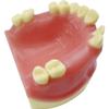 Maxillary Missing Dental Implant Model Oral Teeth Model with Soft Gums Tooth Implant Practice Medical Educational Training Aid Teaching Aids view 4