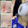 Exemic Pectus Excavatum Vacuum Bell - Pectus Excavatum Orthosis Brace for Adults and Child,Physical Correction of Pectus Excavatum,Vacuum bell therapy(M-M) view 4