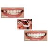 2 Pairs Dentures Cosmetic Teeth Instant Veneers Dentures Temporary Teeth Top and Bottom False, Comfort Fit One Size view 2