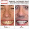 Fake Teeth Braces 2 Pairs Instant Veneers Dentures for Instant Perfect Smile, Temporary Teeth Veneers Upper And Lower Jaw, Missing Tooth Replacement Kit for Men & Women Everyday And Dating view 4