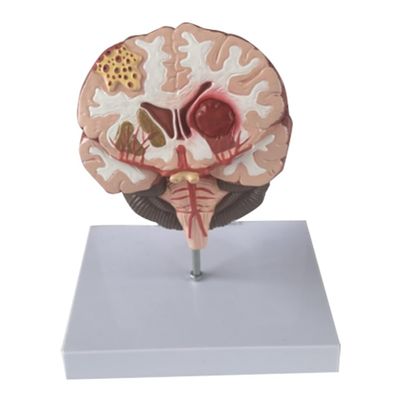 Lnfxkvva Human Brain Disease Model - Brain Pathology Brainstem Hemorrhage Medical Teaching Model - Human Brain Anatomy Model