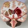 Lnfxkvva Human Brain Disease Model - Brain Pathology Brainstem Hemorrhage Medical Teaching Model - Human Brain Anatomy Model view 2