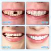 2pair False Teeth,Clip in Veneers Teeth,Snap on Veneers Teeth,Clip on Veneers Top and Bottom,Adjustable Snap Button Veneers Teeth,for Men and Women with Bad Teeth,with Tweezers view 3