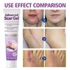 Advanced Scar Gel, Bump Removal, Scar Cream, Scar Removal Cream, Removal Cream, Bump Treatment, Scar Cream For Surgical Scars (3PCS) view 2