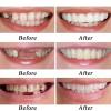 Brigtviee 2 Pairs False Teeth, Silicone Dentures Natural Tones,Clip On Veneers Top And Bottom,Missing Tooth Replacement Kit, Clip In Veneers Teeth For Upper And Lower For Men Women view 4