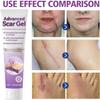 BOVROTIN Advanced Scar Gel,Professional Scar Removal Cream,Silicone Scar Gel,Intensive Scar Cream,For Burn, Acne, Stretch Mark view 3