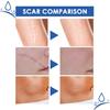 Scar Repair Cream,Repair Scar Cream,Advance Scar Gel,Scar Healing Cream,Scar Remover Cream,Scar Removal Cream for Skin Scar Removal Repair (5 Pcs) view 3