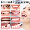 Tooth Filling Repair Kit,Temporary Tooth Repair Kit with Moldable False Teeth,Filling Repair Beads for Fixing Missing,Broken or Chipped Teeth,Reusable Safe Replacement Set view 2