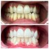 Professional Teeth Whitening Gel 44 HP Dual Barrel Syringe with Catalyst, 5ml Big Size for 3 Times 10 Minutes Application, Dental Grade Pro Tooth Bleaching Gel 1Pack view 2