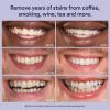 Teeth Whitening Strips - Purple Tooth whitening for Sensitive Teeth - Tooth Stain Removes Stubborn Stains - TeethWhiten Combining Whiter Teeth Colour Correction Mild 14 Strips 7 Treatments view 4