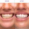 7PCS Purple Teeth Whitening Strips,Tooth Whitening & Colour Correction Kit,Whitening Strips for Sensitive People,Gentle Effective Removes Coffee,Wine & Smoke Stains,Enamel-Safe WHI/tening Strips view 2