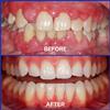 Dental Treatment Toothpaste, 100g Natural Teeth Whitening Toothpaste for Men and Women (1PCS) view 3