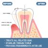 3PCS Gum Repair Gel,Gum Shield Therapy Gel for Receding Gums,Advanced Gu/m Treatment & Protection,Deeply Cleaning G/ums & Teeth,Promotes Gu/m Regrowth & Teeth Repair,Supports Gu/m Health,Oral Care view 4