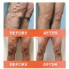 Zvoevo Vein Ease Microneedle Care Patch, 2026 New Vein Target Patches, Zvoevo Varicose Veins Treatment Patches for Legs, Natural Ingredients, for All Skin Types (1 Pack) view 3