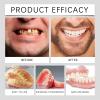 Advanced Customised Full Denture Set, Upper and Lower Denture Reline Kit, Snap On Dentures & Clip On Veneers, Comfortable Natural-Looking Teeth, for Men & Women (2pcs) view 2